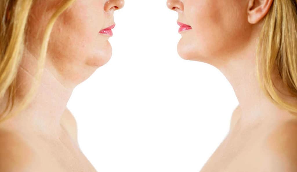 Double Chin treatment Yateley before and after results