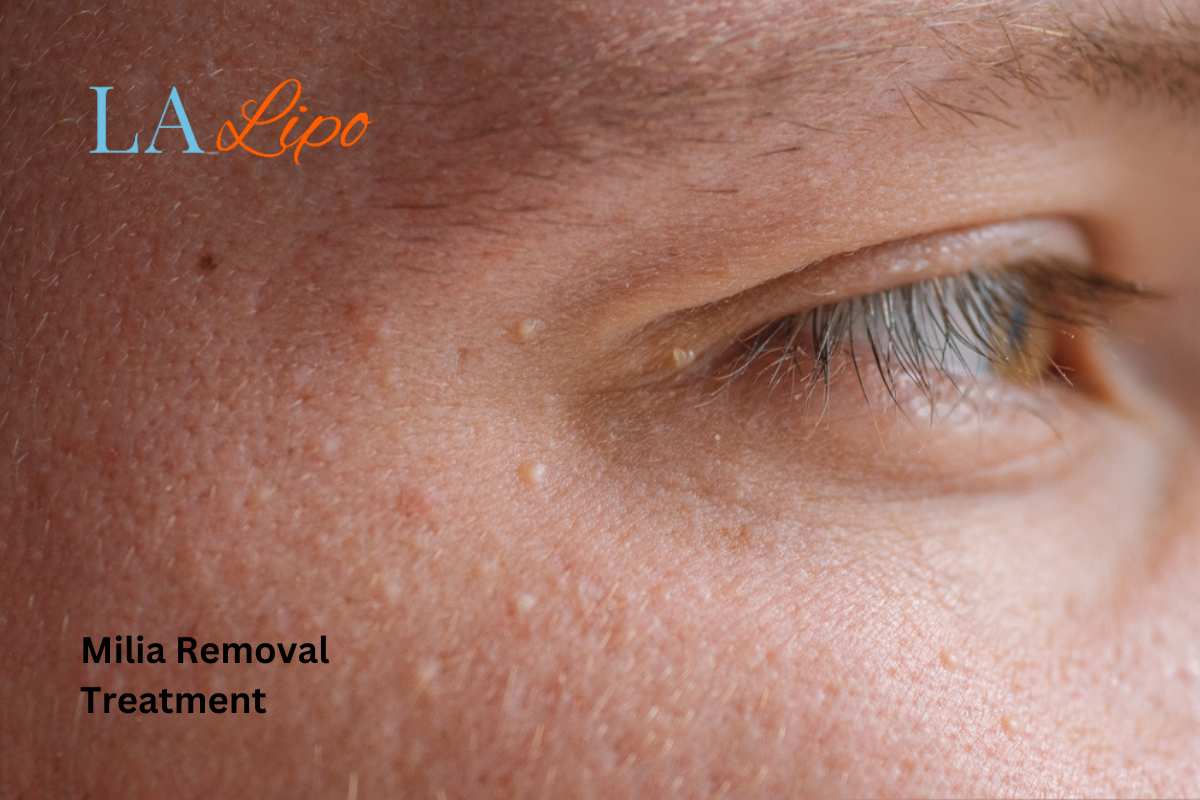 Cryopen Milia Removal: Is It the Easiest and Safest Option Yateley?