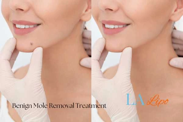 woman's before and after mole removal Yateley results