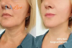 hi-fu for wrinkles Yateley before and after results