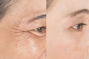 Before and after results of woman - HI-fu wrinkles reduction treatment Yateley