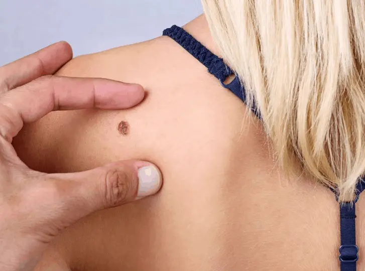 woman having mole removal Yateley consultation before treatment.