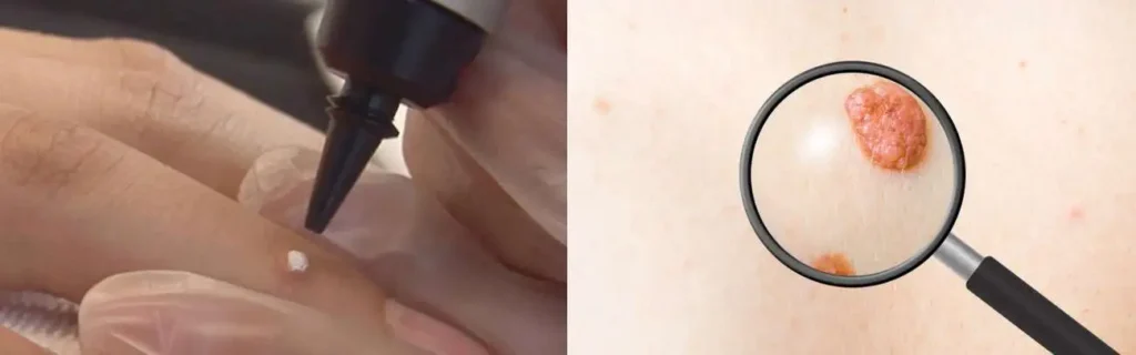 Cryopen for mole removal Yateley - speak to our team today!