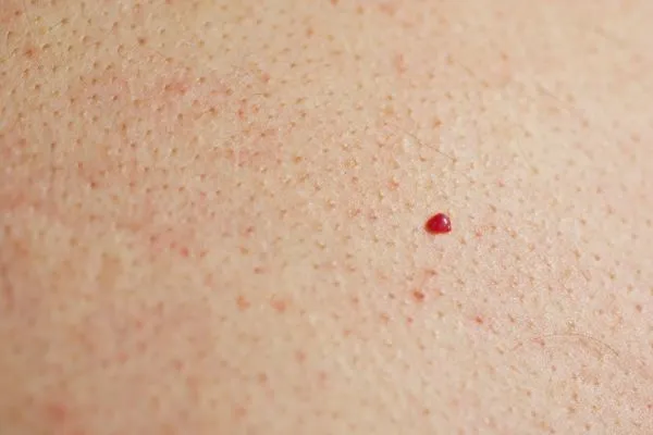 close up of a cherry angioma Yateley