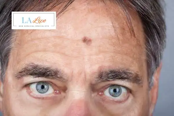 Solar Lentigo Removal Yateley image of man with mark on his forehead