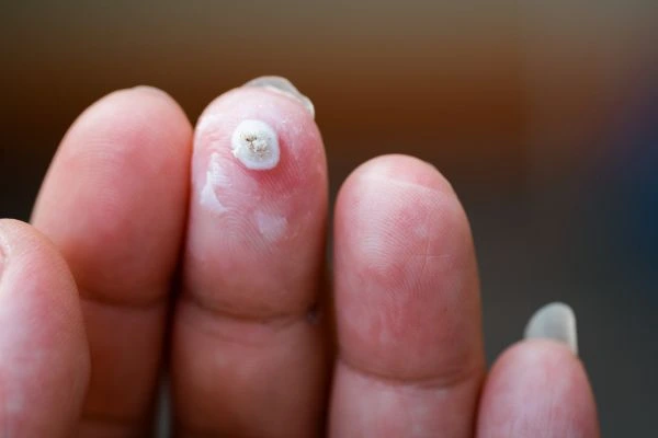 wart on person finger - cryotherapy to treat from LA LIPO Yateley