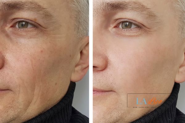 See the amazing results of Morpheus8 Treatment Yateley!
