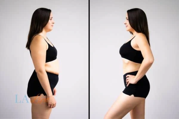 Picture of womans before and after using LA-EMS body sculpting to improve her core strength Yateley
