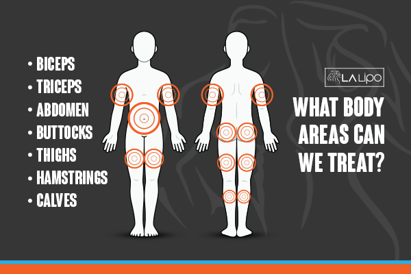 Diagram to show areas you can have LA-EMS Body Sculpting Treatment Yateley