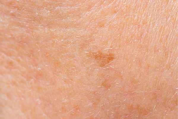 close up picture of age spots Yateley