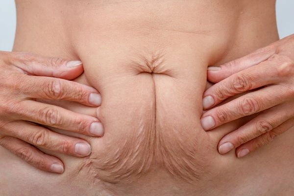 Should I Combine Diastasis Recti Treatment with Body Contouring for Better Results Yateley?