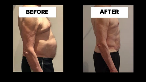 What Symptoms Can Diastasis Recti Cause in Men? Weak Core, Back Pain and Poor Posture Yateley